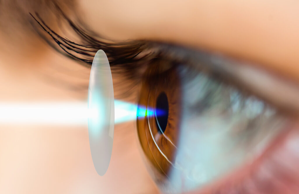 Opération de la cataracte, explication des coûts et du remboursement en 2025